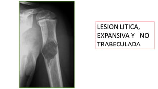 LESION LITICA,
EXPANSIVA Y NO
TRABECULADA
 