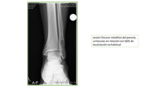 Lesión líticaen metáfisis del peroné,
unilocular,en relacióncon QOS de
localización nohabitual
 