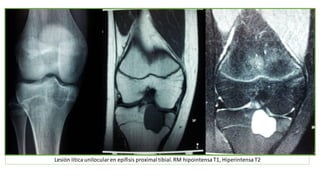 Lesión lítica unilocularen epífisis proximaltibial.RM hipointensa T1, Hiperintensa T2
 