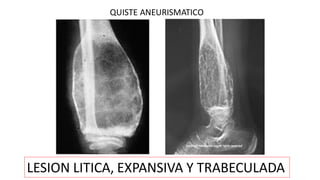 QUISTE ANEURISMATICO
LESION LITICA, EXPANSIVA Y TRABECULADA
 