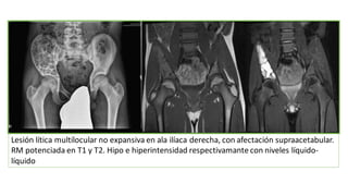 Lesión lítica multilocular no expansiva en ala ilíaca derecha, con afectación supraacetabular.
RM potenciada en T1 y T2. Hipo e hiperintensidad respectivamante con niveles líquido-
líquido
 