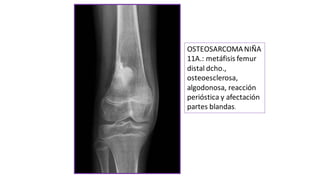 OSTEOSARCOMANIÑA
11A.: metáfisis femur
distal dcho.,
osteoesclerosa,
algodonosa, reacción
perióstica y afectación
partes blandas.
 