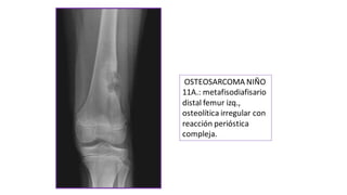 OSTEOSARCOMA NIÑO
11A.: metafisodiafisario
distal femur izq.,
osteolítica irregular con
reacción perióstica
compleja.
 