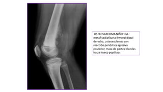 OSTEOSARCOMANIÑO 10A.:
metafisodiafisaria femoraldistal
derecha, osteoesclerosa con
reacción perióstica agresiva
posterior, masa de partes blandas
hacia hueco poplíteo.
 