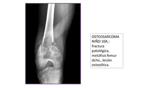 OSTEOSARCOMA
NIÑO 10A.:
fractura
patológica,
metáfisis femur
dcho., lesión
osteolítica.
 
