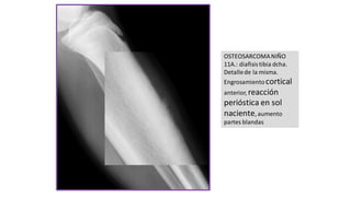 OSTEOSARCOMANIÑO
11A.: diafisis tibia dcha.
Detallede la misma.
Engrosamientocortical
anterior, reacción
perióstica en sol
naciente, aumento
partes blandas
 