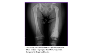 OSTEOSARCOMANIÑA 23 MESES: Patrón infiltrativo
difuso cortical y esponjoso distal fémur izquierdo.
Componentede partes blandas
 