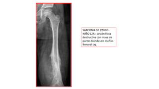 SARCOMA DE EWING
NIÑO 12A.: Lesión lítica
destructiva con masa de
partes blandasen diafisis
femoral izq.
 