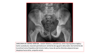 SARCOMA DE EWING NIÑA 8A.: Lesión blástica,radiodensa,rama isquiopúbica izqday
techo acetabular,reacción perióstica en vertiente de agujero obturador; borramientode
la cortical rama iliopúbica delmismo ladoy masa de partes blandasadyacenteque
desplaza hacia dcha. ampollarectal.
 