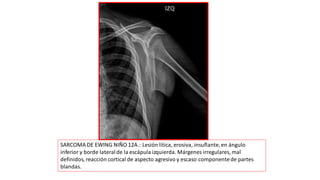 SARCOMA DE EWING NIÑO 12A.: Lesión lítica, erosiva, insuflante,en ángulo
inferior y borde lateralde la escápula izquierda. Márgenes irregulares, mal
definidos, reacción cortical de aspecto agresivo y escaso componentede partes
blandas.
 