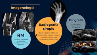 Imagenología
RM
Sinovitis, derrames
articulares,
cambios en hueso y
méd ósea.
Radiografía
simple
Edema de partes blandas
S...