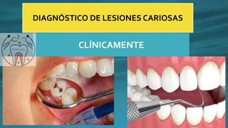 DIAGNÓSTICO DE LESIONES CARIOSAS
CLÍNICAMENTE
 