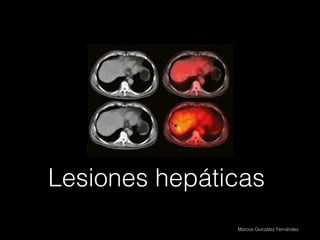 Lesiones hepáticas
               Marcos González Fernández
 