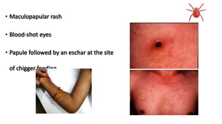 Diagnosis & Management of Scrub Typhus-.pptx