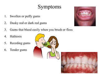 Symptoms
1. Swollen or puffy gums
2. Dusky red or dark red gums
3. Gums that bleed easily when you brush or floss
4. Halitosis
5. Receding gums
6. Tender gums
 