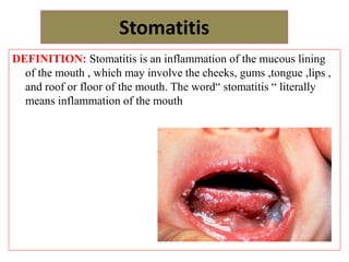 Stomatitis
DEFINITION: Stomatitis is an inflammation of the mucous lining
of the mouth , which may involve the cheeks, gums ,tongue ,lips ,
and roof or floor of the mouth. The word“ stomatitis “ literally
means inflammation of the mouth
 