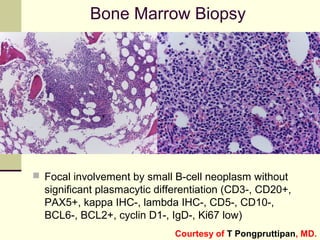 Bone Marrow Biopsy
 Focal involvement by small B-cell neoplasm without
significant plasmacytic differentiation (CD3-, CD20+,
PAX5+, kappa IHC-, lambda IHC-, CD5-, CD10-,
BCL6-, BCL2+, cyclin D1-, IgD-, Ki67 low)
Courtesy of T Pongpruttipan, MD.
 