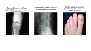 Dactilitis o dedo en salchicha
Espondiloartropatias en especial de
la artritis psoriásica.
Condrocalcinosis de rodilla por
pseudogota (enfermedad por deposición
de pirofosfatos de calcio)
Sindesmofitos o fitos son típicos
de la espondilitis anquilosante
 