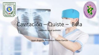 Cavitación – Quiste – Bula
Lesiones en el pulmón
Joan-Angello Amadeus Flores García
 