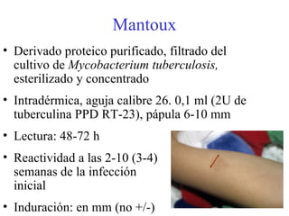 Mantoux Derivado proteico purificado, filtrado del cultivo de  Mycobacterium tuberculosis,  esterilizado y concentrado Intradérmica, aguja calibre 26. 0,1 ml (2U de tuberculina PPD RT-23), pápula 6-10 mm Lectura: 48-72 h Reactividad a las 2-10 (3-4)  semanas de la infección  inicial Induración: en mm (no +/-) 