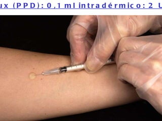 Mantoux (PPD): 0,1 ml intradérmico: 2 UI-RT23 