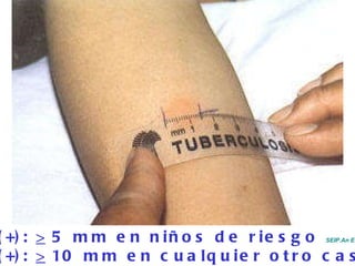 PPD (+):  >  5 mm en niños de riesgo  SEIP.An Esp Ped 2003;59:582 PPD (+):  >  10 mm en cualquier otro caso 