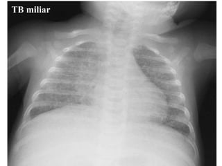 TB miliar   