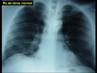 Rx de tórax normal 