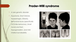 Prader–Willi syndromePrader–Willi syndrome
 A rare genetic disorder
 Hypotonia, Short Stature,
Hyperphagia, Obesity,
Behavioral issues (specifically
OCD-like behaviors), Small
hands and feet,
Hypogonadism, and mild
intellectual disability
 