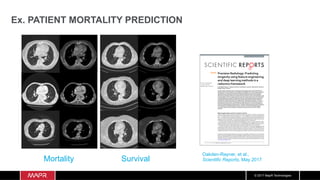© 2017 MapR Technologies
Ex. PATIENT MORTALITY PREDICTION
1Scientific RepoRts | 7: 1648 | DOI:10.1038/s41598-017-01931-w
www.nature.com/scientificreports
Precision Radiology: Predicting
longevity using feature engineering
and deep learning methods in a
radiomics framework
LukeOakden-Rayner1,2
,GustavoCarneiro3
,Taryn Bessen1
, JacintoC. Nascimento4
,Andrew P.
Bradley5
& Lyle J. Palmer2
Precision medicine approaches rely on obtaining precise knowledge of the true state of health of an
individual patient, which results from a combination of their genetic risks and environmental exposures.
This approach is currently limited by the lack of effective and efficient non-invasive medical tests to
define the full range of phenotypic variation associated with individual health. Such knowledge is
critical for improved early intervention, for better treatment decisions, and for ameliorating the steadily
worsening epidemic of chronic disease.We present proof-of-concept experiments to demonstrate how
routinely acquired cross-sectionalCT imaging may be used to predict patient longevity as a proxy for
overall individual health and disease status using computer image analysis techniques. Despite the
limitations of a modest dataset and the use of off-the-shelf machine learning methods, our results are
comparable to previous ‘manual’ clinical methods for longevity prediction.This work demonstrates
that radiomics techniques can be used to extract biomarkers relevant to one of the most widely used
outcomes in epidemiological and clinical research – mortality, and that deep learning with convolutional
neural networks can be usefully applied to radiomics research.Computer image analysis applied
to routinely collected medical images offers substantial potential to enhance precision medicine
initiatives.
Measuring phenotypic variation in precision medicine
Precision medicine has become a key focus of modern bioscience and medicine, and involves “prevention and
treatment strategies that take individual variability into account”, through the use of “large-scale biologic data-
bases … powerful methods for characterizing patients … and computational tools for analysing large sets of
data”1
. The variation within individuals that enables the identification of patient subgroups for precision medicine
strategies is termed the “phenotype”. The observable phenotype reflects both genomic variation and the accumu-
lated lifestyle and environmental exposures that impact biological function - the exposome2
.
Precision medicine relies upon the availability of useful biomarkers, defined as “a characteristic that is objec-
tively measured and evaluated as an indicator of normal biological processes, pathogenic processes, or phar-
macological responses to a therapeutic intervention”3
. A ‘good’ biomarker has the following characteristics: it is
sensitive, specific, predictive, robust, bridges clinical and preclinical health states, and is non-invasive4
.
Genomics can produce good biomarkers useful for precision medicine5
. There has been significant success in
exploring human genetic variation in the field of genomics, where data-driven methods have highlighted the role
of human genetic variation in disease diagnosis, prognosis, and treatment response6
. However, for the chronic
and age-related diseases which account for the majority of morbidity and mortality in developed nations7
and
worldwide8
, the majority (70–90%) of observable phenotypic variation is related to non-genetic determinants9
.
1
Department of a io o o a e ai e ospita ort errace e ai e 5000 ustra ia. c oo of u ic
ea t e ni ersit of e ai e ort errace e ai e 5000 ustra ia. 3
c oo of omputer cience e
ni ersit of e ai e ort errace e ai e 5000 ustra ia. 4
Instituto uperior cnico is on ortu a .
5
c oo of Information ec no o an ectrica n ineerin e ni ersit of ueens an ui in 78 t ucia
D 40 7 ueens an ustra ia. orrespon ence an re uests for materia s s ou e a resse to .O. emai :
u eoa enra ner mai .com)
Received: 8 December 2016
Accepted: 6 April 2017
Published: xx xx xxxx
OPEN
Oakden-Rayner, et al.,
Scientific Reports, May 2017
com/scientificreports/
Figure 4. Images at the level of the proximal left anterior descending coronary artery, with the most strongly
predicted mortality and survival cases selected by averaging the predictions from the deep learning and
engineered feature models. The mortality cases (left side) demonstrate prominent visual changes of emphysema,
cardiomegaly, vascular disease and osteopaenia. The survival cases (right side) appear visually less diseased and
frail.
Mortality Survival
 