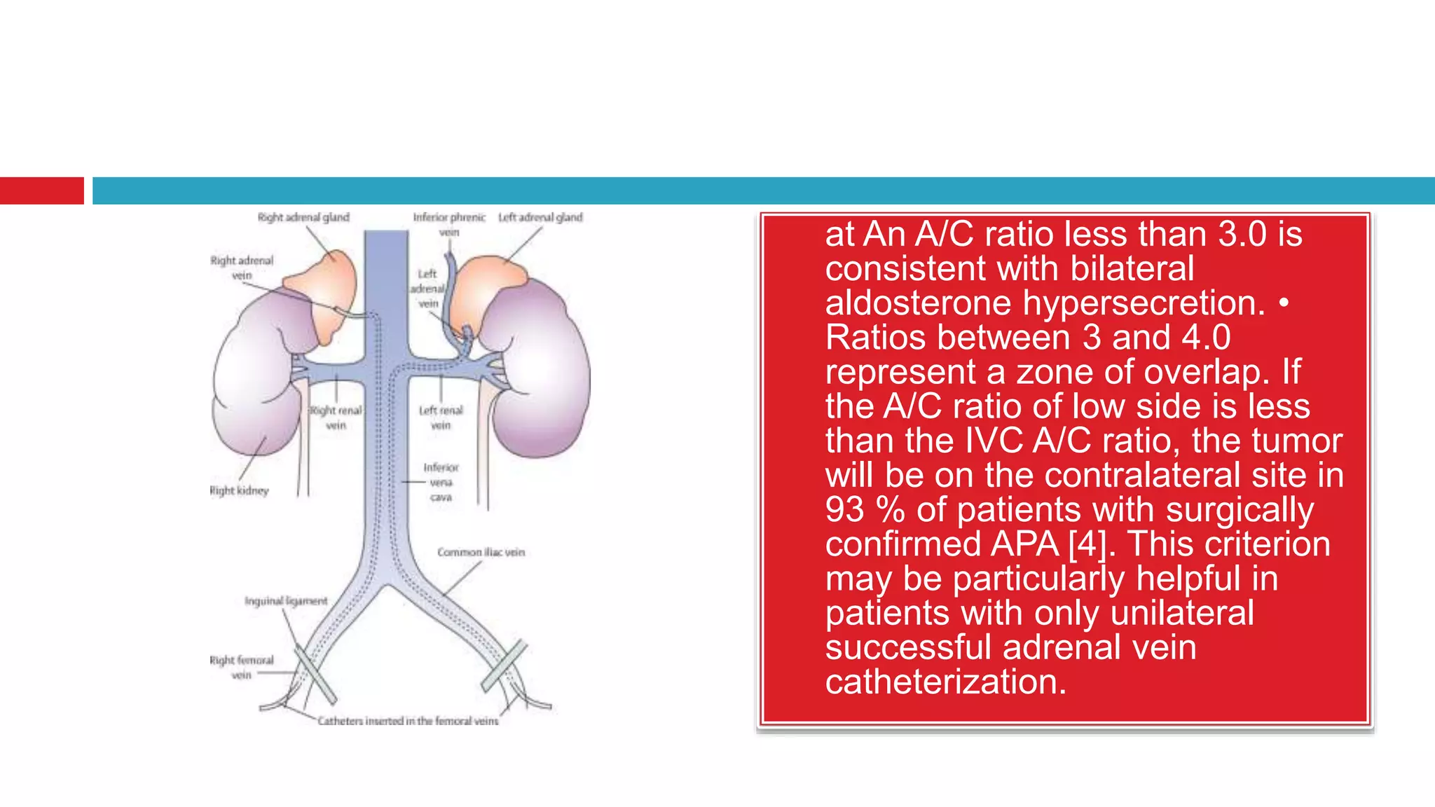  at An A/C ratio less than 3.0 is
consistent with bilateral
aldosterone hypersecretion. •
Ratios between 3 and 4.0
represent a zone of overlap. If
the A/C ratio of low side is less
than the IVC A/C ratio, the tumor
will be on the contralateral site in
93 % of patients with surgically
confirmed APA [4]. This criterion
may be particularly helpful in
patients with only unilateral
successful adrenal vein
catheterization.
 