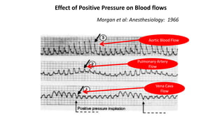 Morgan et al: Anesthesiology: 1966
Effect of Positive Pressure on Blood flows
Aortic Blood Flow
Pulmonary Artery
Flow
Vena Cava
Flow
 