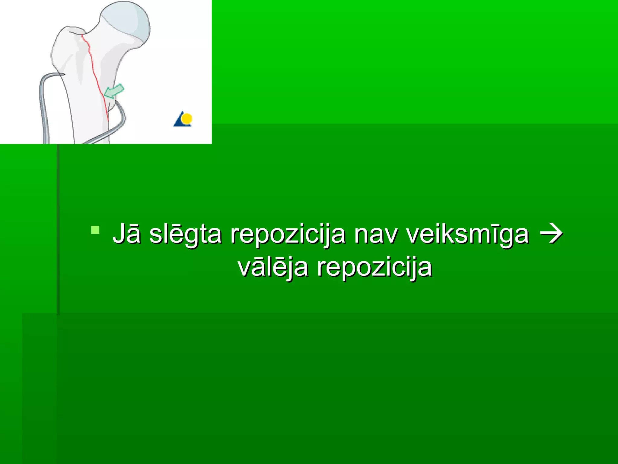  Jā slēgta repozicija nav veiksmīga 
             vālēja repozicija
 