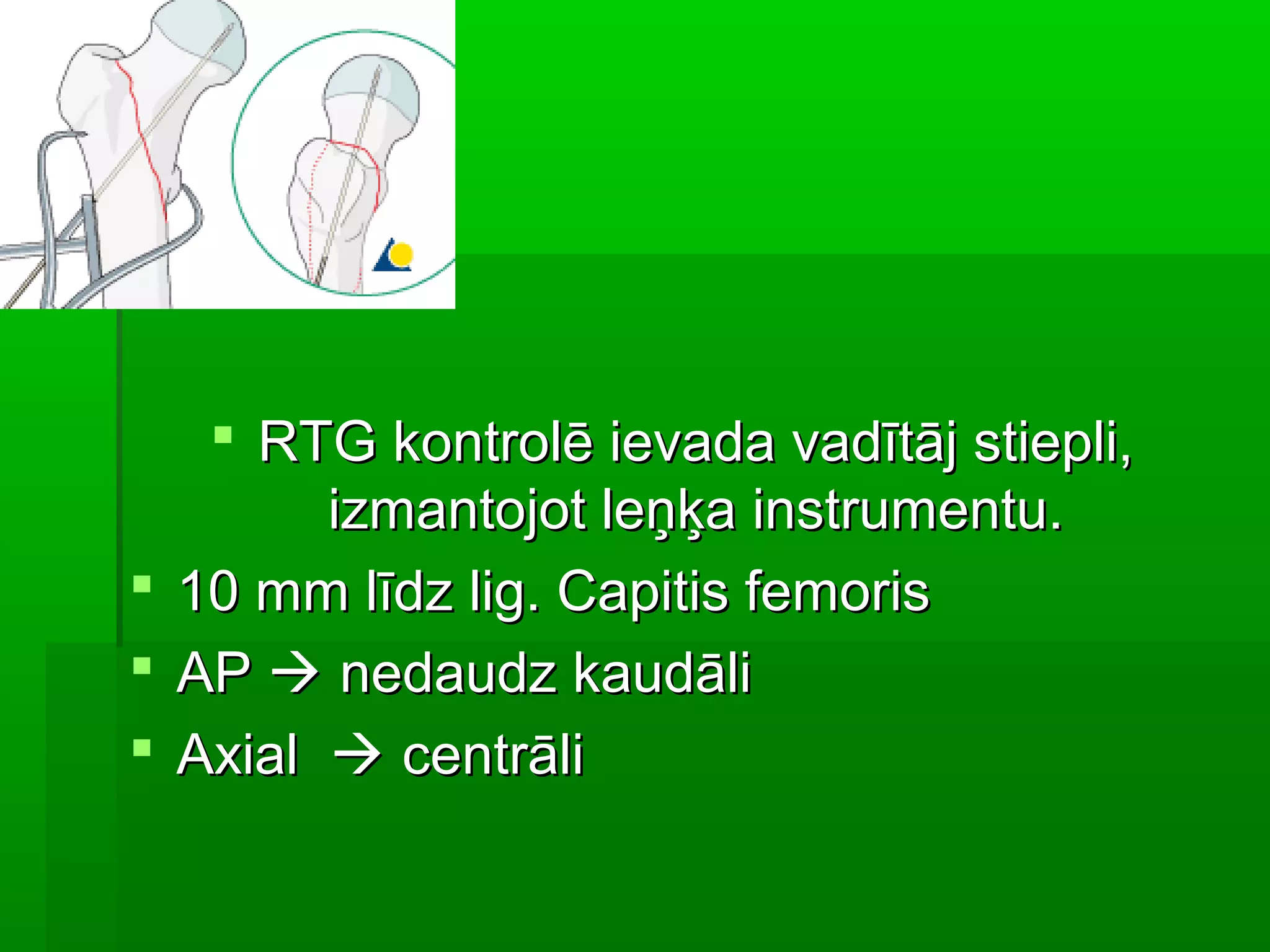  RTG kontrolē ievada vadītāj stiepli,
        izmantojot leņķa instrumentu.
 10 mm līdz lig. Capitis femoris
 AP  nedaudz kaudāli
 Axial  centrāli
 