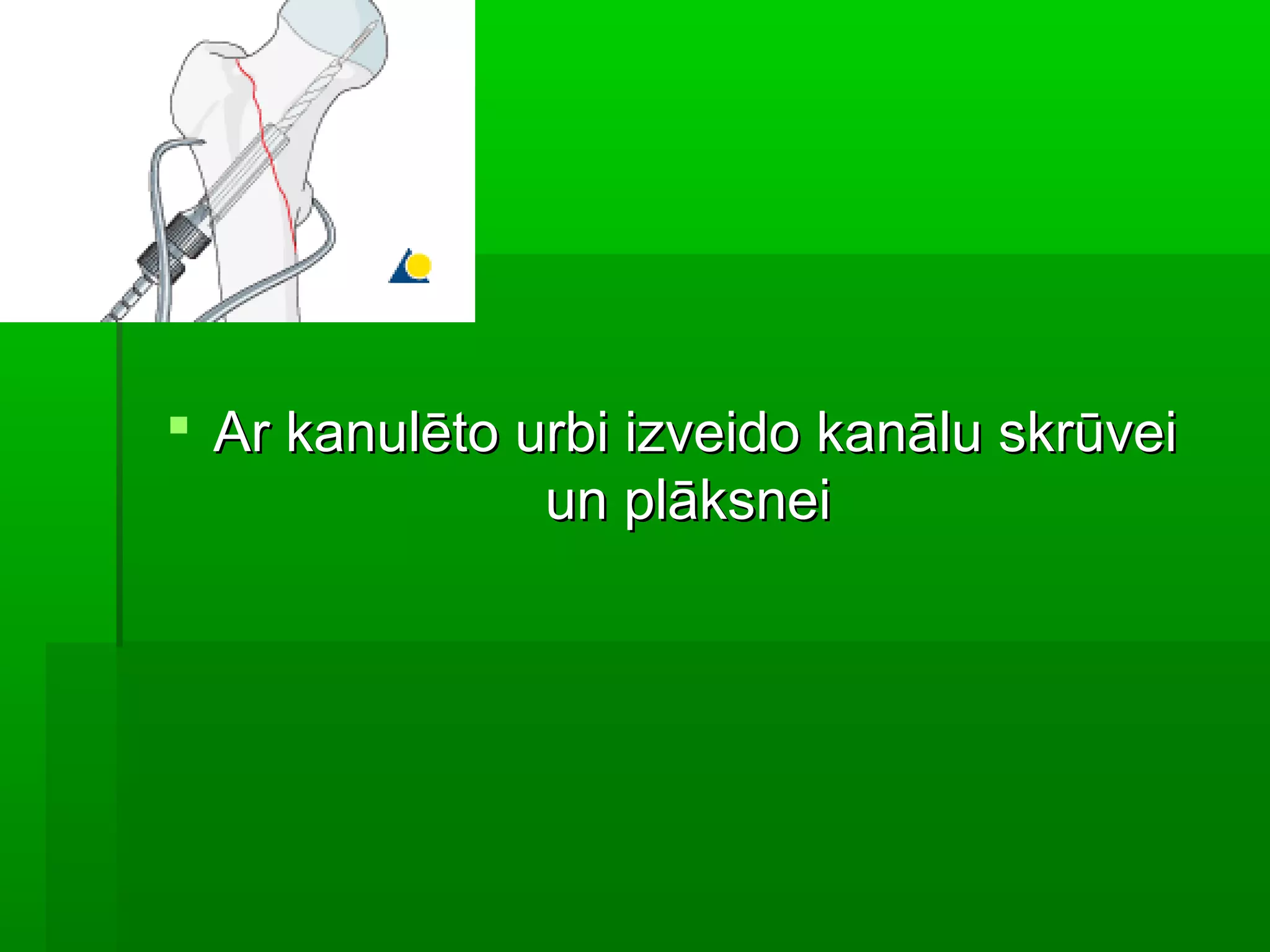  Ar kanulēto urbi izveido kanālu skrūvei
               un plāksnei
 