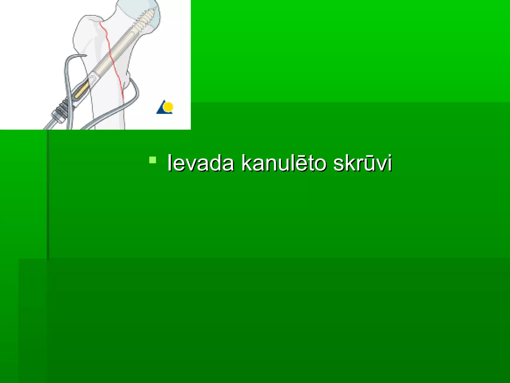  Ievada kanulēto skrūvi
 