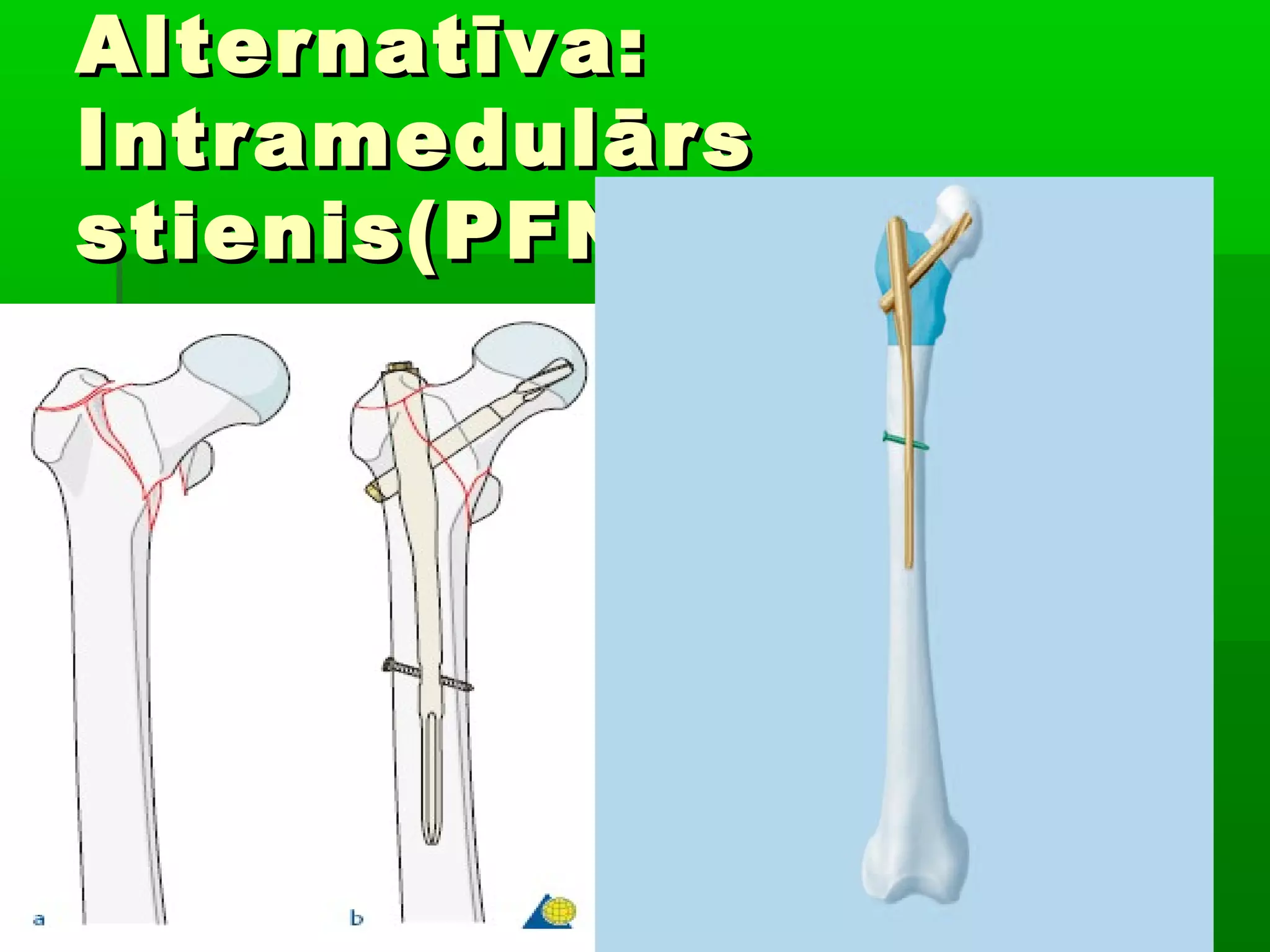 Alternatīva:
Intramedulārs
stienis(PFNA)
 