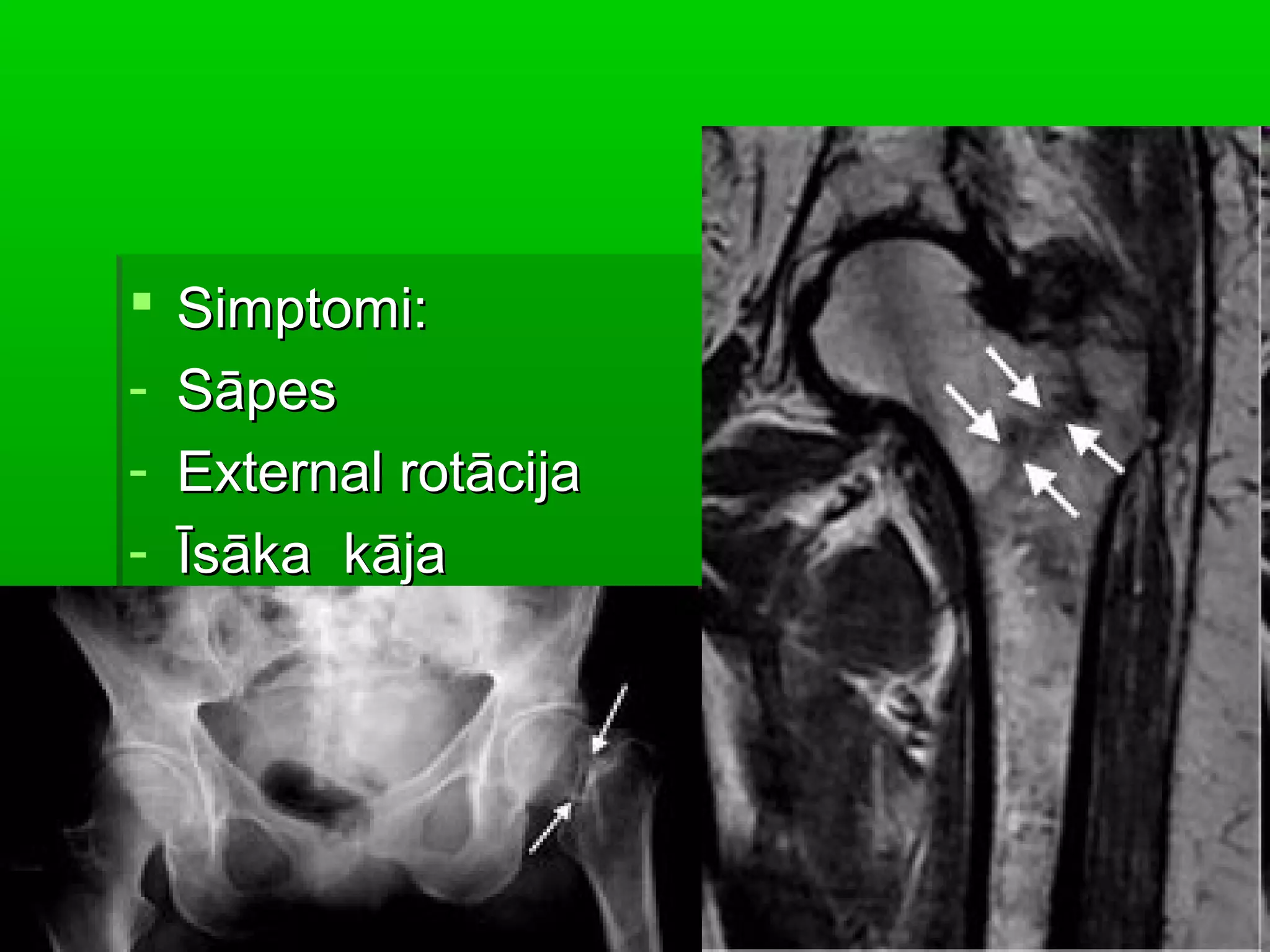    Simptomi:
-   Sāpes
-   External rotācija
-   Īsāka kāja
 
