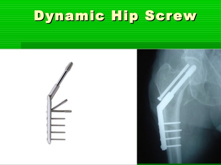 Dynamic hip screw