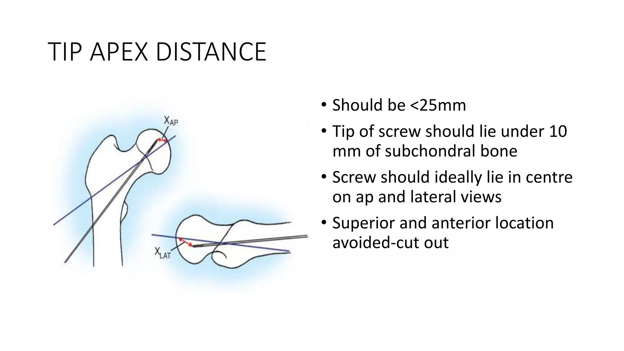 TIP APEX DISTANCE
• Should be <25mm
• Tip of screw should lie under 10
mm of subchondral bone
• Screw should ideally lie in centre
on ap and lateral views
• Superior and anterior location
avoided-cut out
 