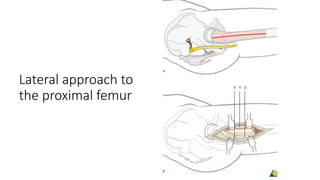 Lateral approach to
the proximal femur
 