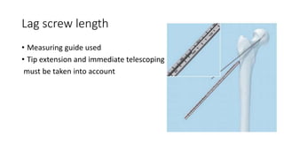 Lag screw length
• Measuring guide used
• Tip extension and immediate telescoping
must be taken into account
 