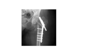 Dynamic hip screw