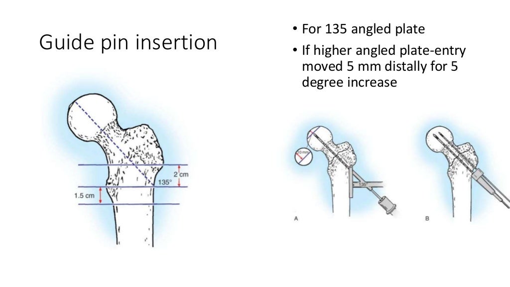 Dynamic hip screw