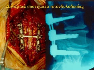 Δυναμικά σσυυσσττήήμμαατταα σσπποοννδδυυλλοοδδεεσσίίααςς 
 