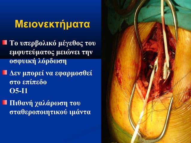 Dynamic stabilization | PPT