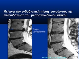 Μείωνει την ενδοδισκική πίεση ευνοώντας την 
επανυδάτωση του μεσοσπονδύλιου δίσκου 
Pre-op 6 μήνες 
μετεγχειρητικά 
Swanson K, et al. Spine 2003 
 