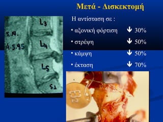 Μετά - Δισκεκτομή 
Η αντίσταση σε : 
• αξονική φόρτιση  30% 
• στρέψη  50% 
• κάμψη  50% 
• έκταση  70% 
 