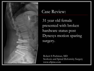 Case Review:
31 year old female
presented with broken
hardware status post
Dynesys motion sparing
surgery.


Robert S Pashman, MD
Scoliosis and Spinal Deformity Surgery
www.eSpine.com
 