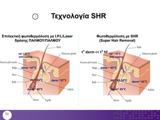 epi ~ 25°C
with cooling
derm ~37°C
HF ~ 65°C
derm~ 40°C
derm ~37°C
Τεχνολογία SHR
Epi ~ 25°C
with cooling
derm ~ 45°C
HF ~ 45-50°C
derm~ 45°C
derm~ 45°C
Φωτοθερμόλυση με SHR
(Super Hair Removal)
t° derm << t° hf
Επιλεκτική φωτοθερμόλυση με I.P.L/Laser
δράσης ΠΑΛΜΟΥ/ΠΑΛΜΟΥ
50
 